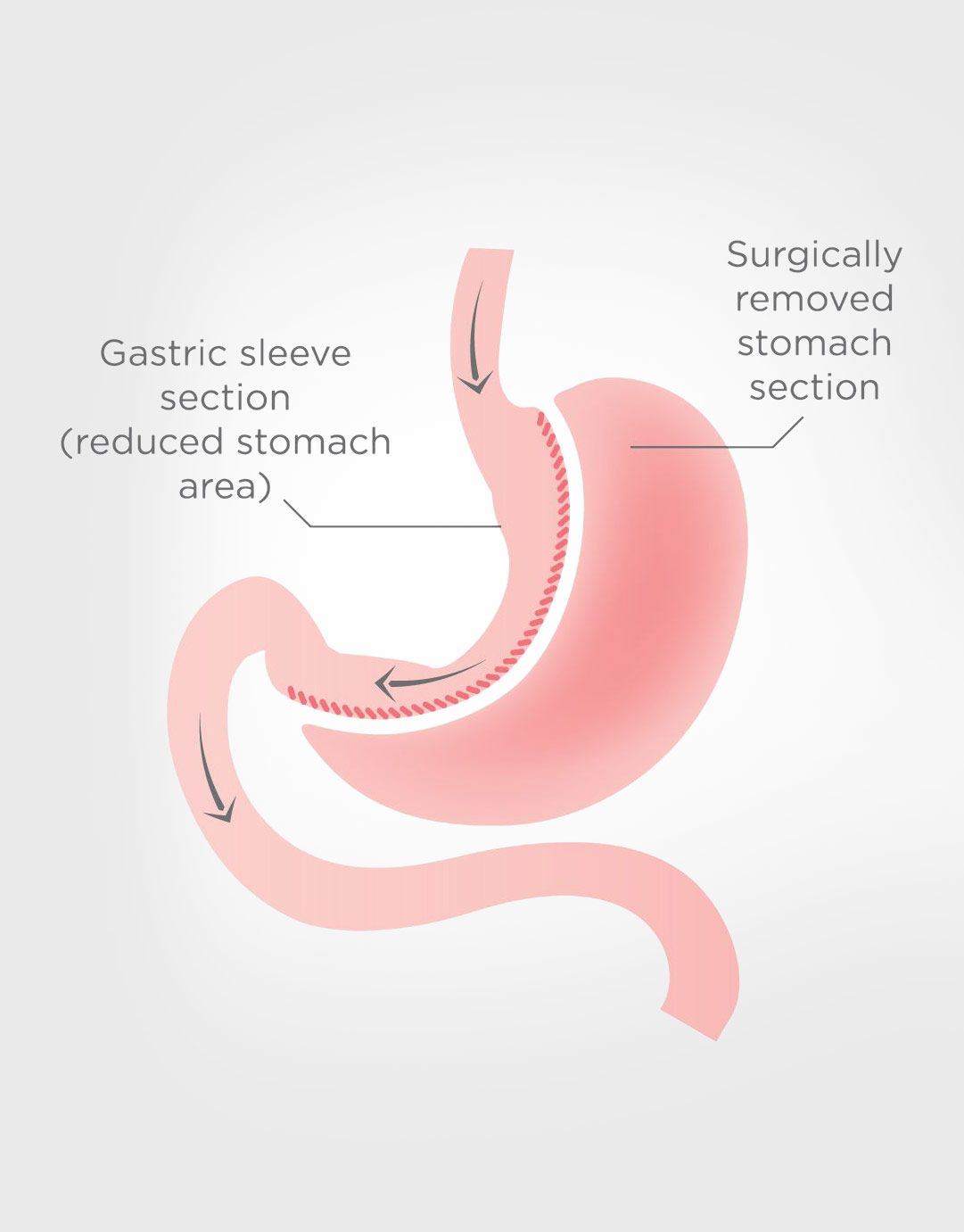 diagram of gastric sleeve surgery